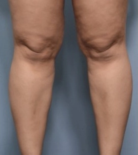 Липосакция коленей - фото до