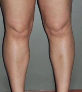 Липосакция коленей - фото після
