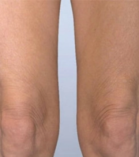 Липосакция коленей - фото після