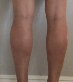 Липосакция голеней - фото після