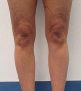 Липосакция голеней - фото до