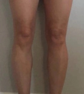 Липосакция голеней - фото після