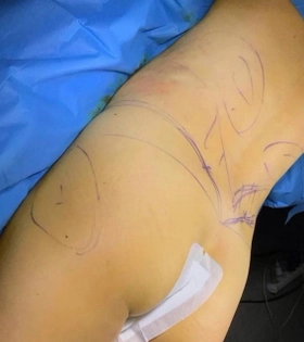 Липофилинг ягодиц - фото до