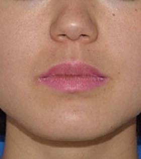 Липосакция щек - фото до