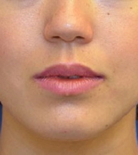 Липосакция щек - фото після