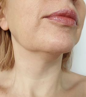 Липосакция подбородка - фото до