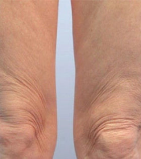 Липосакция коленей - фото до