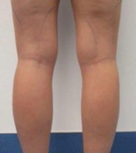 Липосакция голеней - фото до