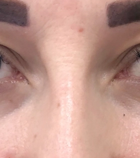 Круговая блефаропластика. Хирург Саркисян А.Г. - фото до