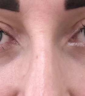 Круговая блефаропластика. Хирург Саркисян А.Г. - фото після