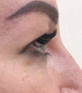 Верхняя блефаропластика_1 - фото до