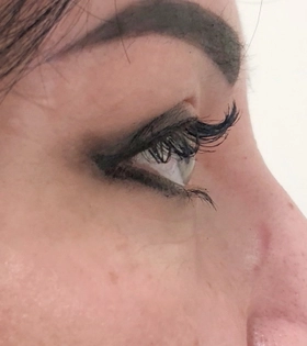 Верхняя блефаропластика_1 - фото після