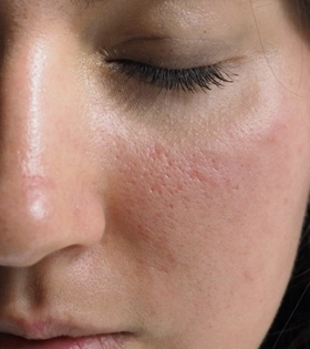 Лазерная шлифовка постакне - фото до