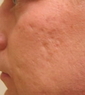 Лазерная шлифовка постакне - фото до