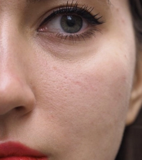 Лазерная шлифовка постакне - фото після