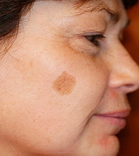 Лазерное удаление пигментации - фото до