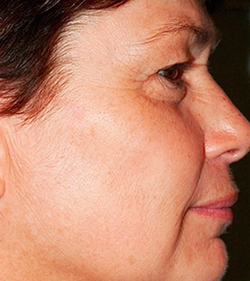 Лазерное удаление пигментации - фото після