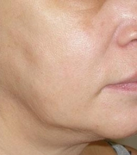 Лазерное омоложение - фото до