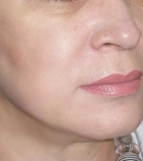 Лазерное омоложение - фото після