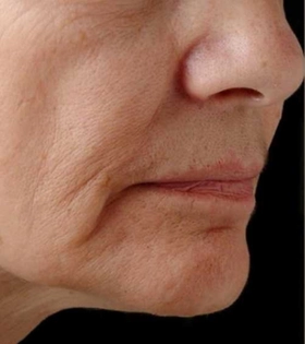 Лазерное омоложение - фото до