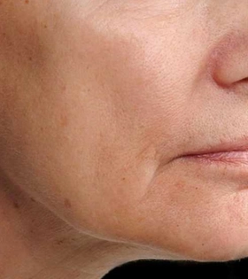 Лазерное омоложение - фото після