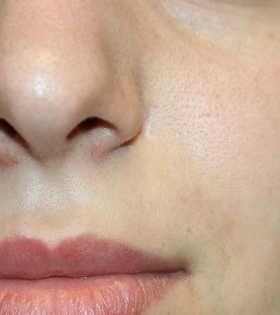 Удаление атеромы  - фото після