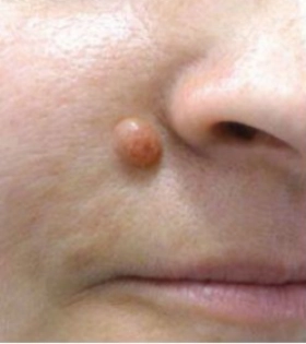 Удаление атеромы  - фото до