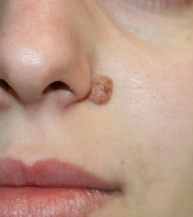 Удаление атеромы  - фото до