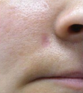 Удаление атеромы  - фото після