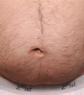 Лазерное удаление пупочной грыжи - фото після