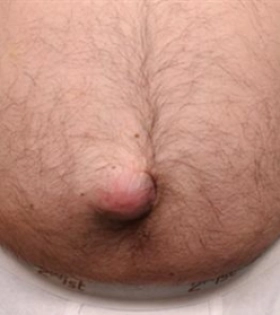 Удаление грыжи живота - фото до