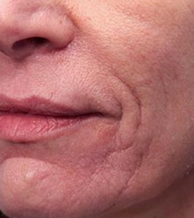 Радиоволновой рф лифтинг - фото до