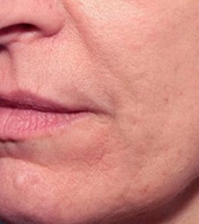 Радиоволновой рф лифтинг - фото після