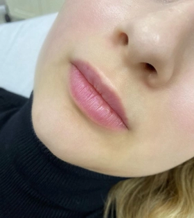 Увеличение и коррекция губ - фото до