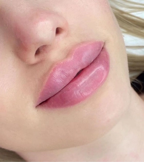 Увеличение и коррекция губ - фото після