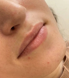 Увеличение и коррекция губ - фото до