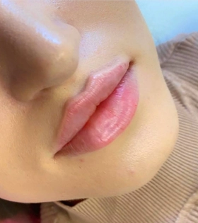 Увеличение и коррекция губ - фото після