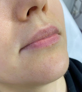 Увеличение и коррекция губ - фото до