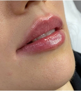 Увеличение и коррекция губ - фото після