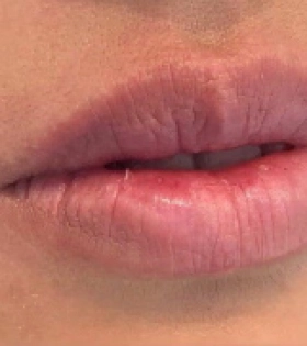 Увеличение и коррекция губ - фото до