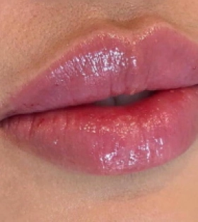 Увеличение и коррекция губ - фото після