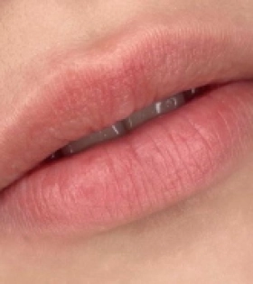 Увеличение и коррекция губ - фото до