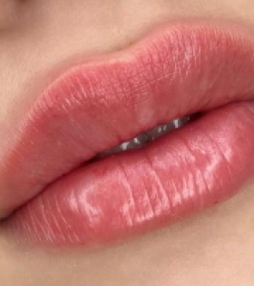 Увеличение и коррекция губ - фото після