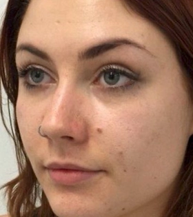 Контурная пластика скул - фото до