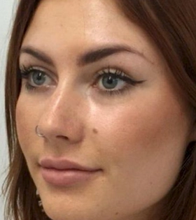 Контурная пластика скул - фото після