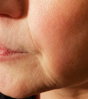 Коррекция носогубных складок - фото до