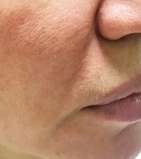 Коррекция носогубных складок - фото до