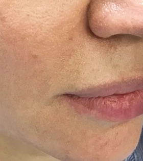 Коррекция носогубных складок - фото після