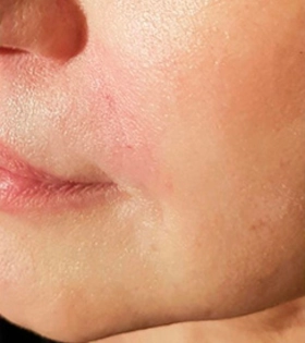 Коррекция носогубных складок - фото після