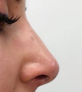 Контурная ластика носа филлерами - фото після